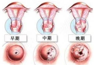 揭秘 | 宫颈糜烂有什么症状和现象!